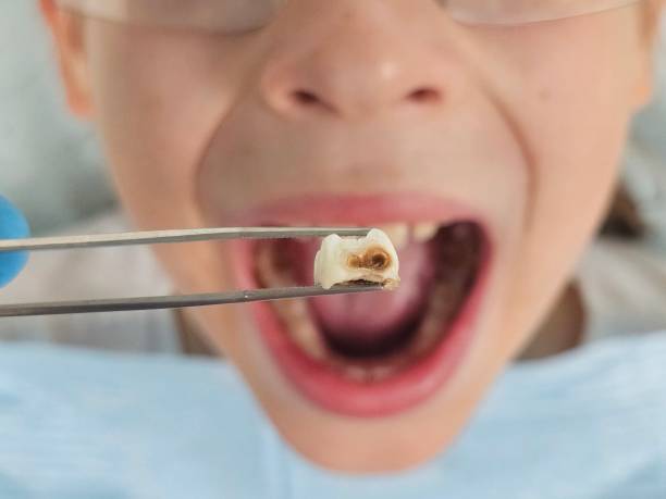 Best Emergency Tooth Extraction in San Felipe, TX